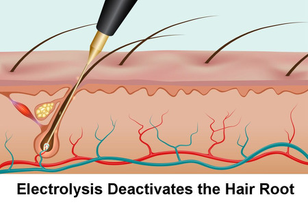 Electrolysis Deactivates the Root of the Hair